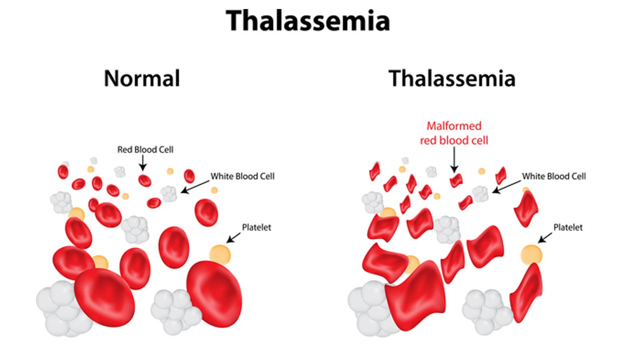 goi xet nghiem sang loc benh thalassemia