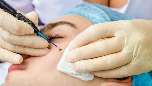 SCC chẩn đoán ung thư biểu mô tế bào vảy