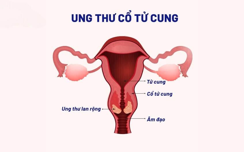 tam-soat-ung-thu-co-tu-cung-nhung-dieu-can-biet-2