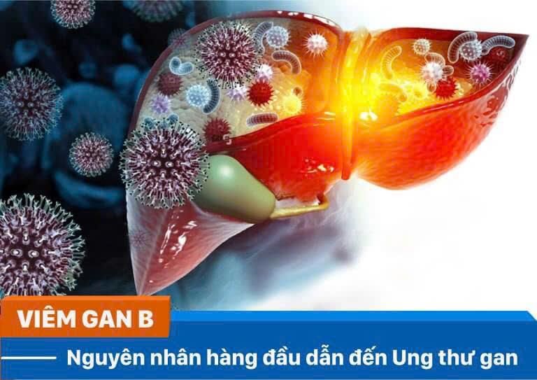 Viêm gan B - Nguyên nhân hàng đầu dẫn đến ung thư gan