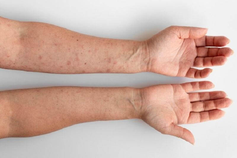 Xét nghiệm 91 dị nguyên: Cách phát hiện và điều trị dị ứng hiệu quả