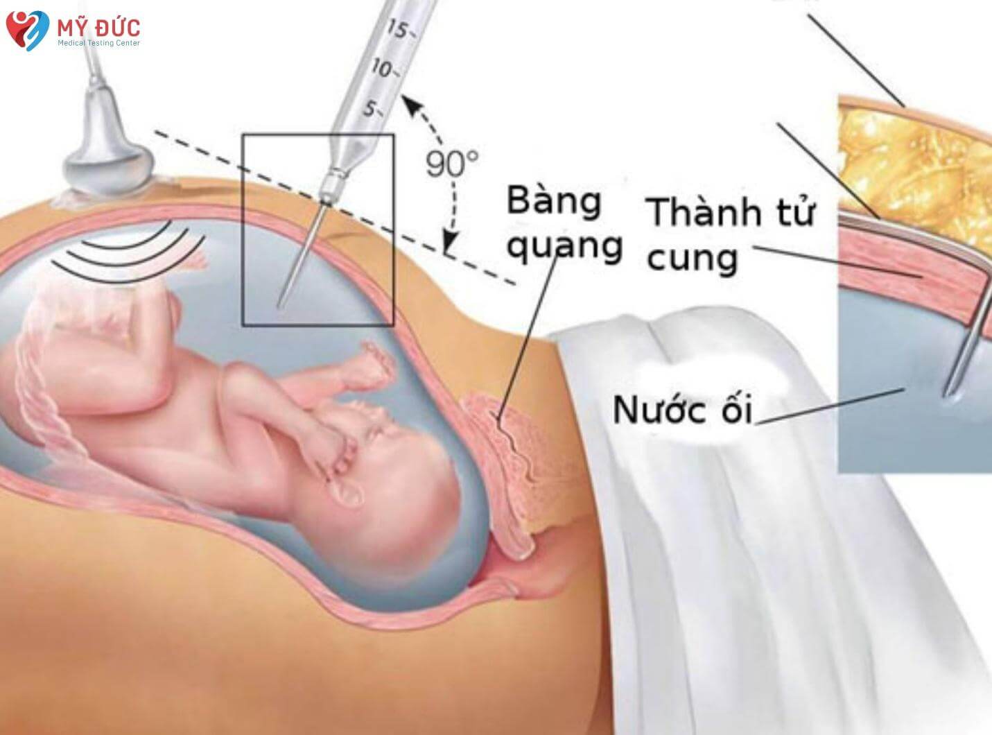 xet-nghiem-adn-thai-nhi-la-gi-2