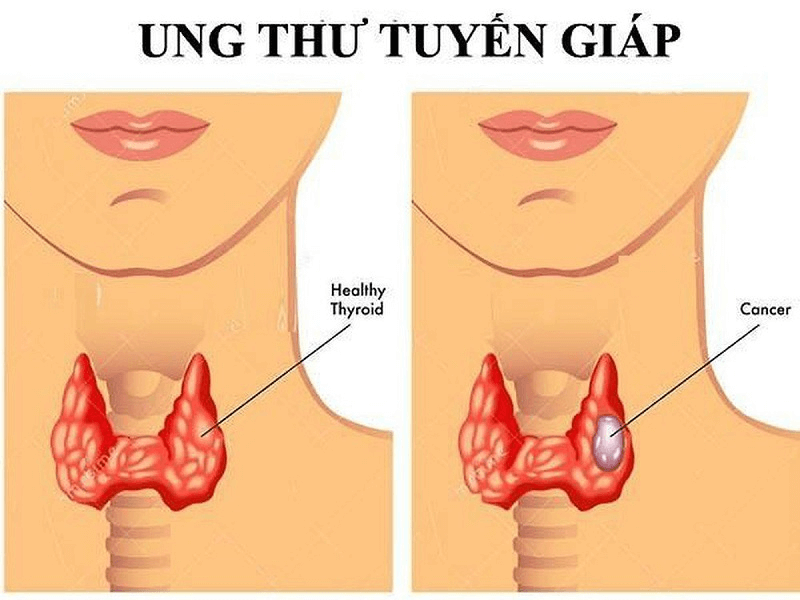 Xét nghiệm Anti-Tg giúp theo dõi và điều trị ung thư tuyến giáp
