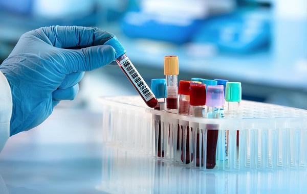Xét nghiệm Ca 72-4 trong chẩn đoán ung thư dạ dày