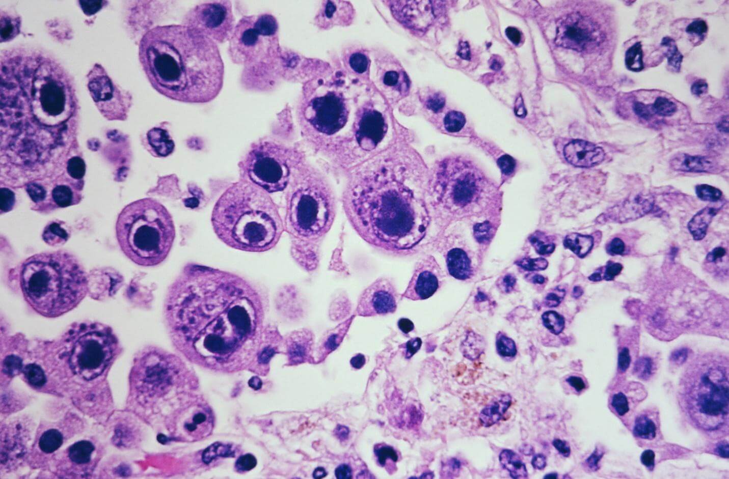 xet-nghiem-cmv-co-y-nghia-nhu-the-nao-2