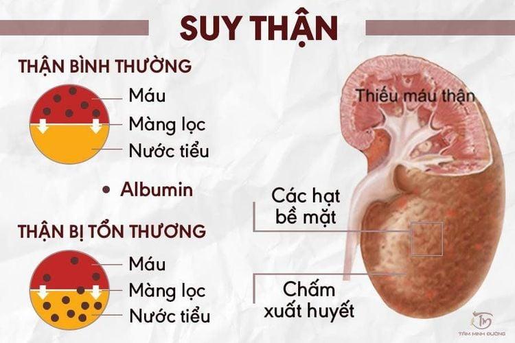 xet-nghiem-creatinin-tam-soat-chuc-nang-than-2