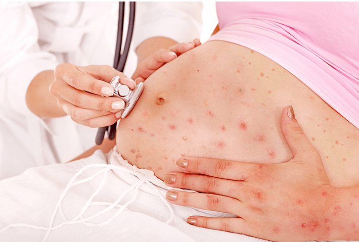 xet-nghiem-khang-the-thuy-dau-vzv-zora-virus-2