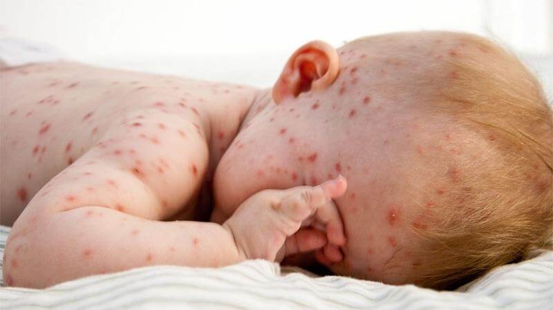 xet-nghiem-khang-the-thuy-dau-vzv-zora-virus-3