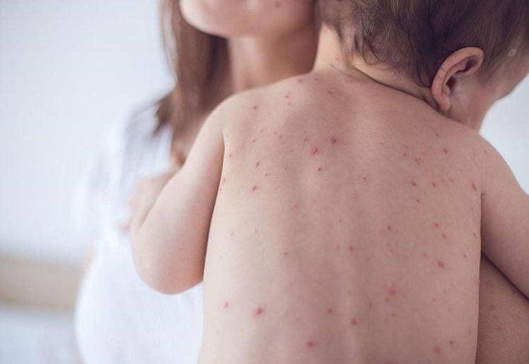 Xét nghiệm kháng thể thuỷ đậu - VZV (Zora virus)
