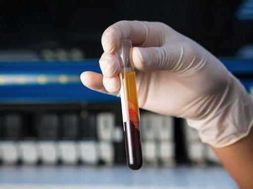 Xét nghiệm Thromboplastin một phần hoạt hoá (aPTT)