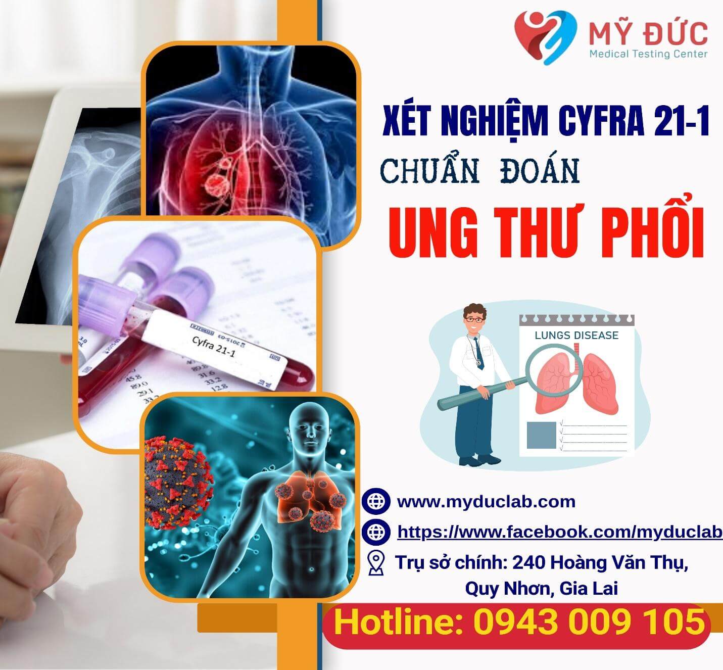 y-nghia-xet-nghiem-cyfra-21-1-trong-ung-thu-phoi-3